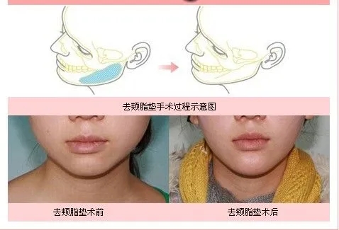 去頰脂墊會(huì)不會(huì)很快變老?哪些人適合做去頰脂墊?