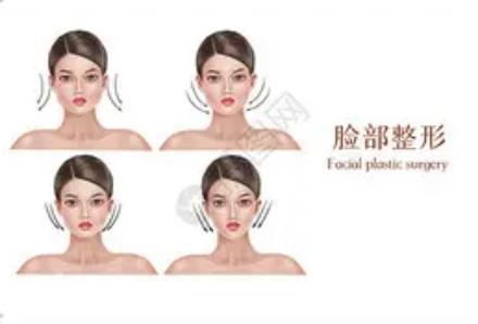 面部整形整容貴嗎?