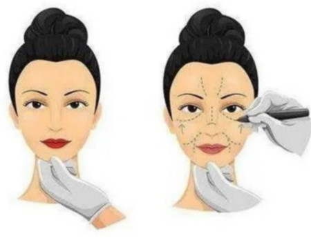 果酸換膚有哪些危害呢