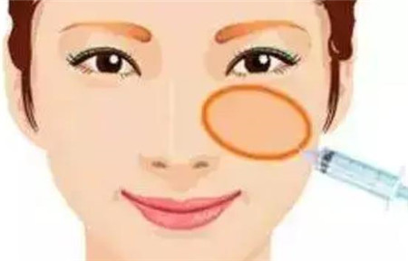 玻尿酸填充淚溝的價(jià)格與哪些因素有關(guān)