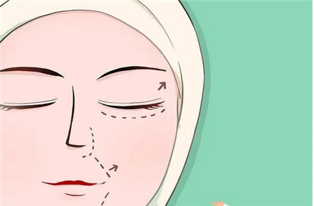 全切雙眼皮手術(shù)要多久才能恢復(fù)自然?