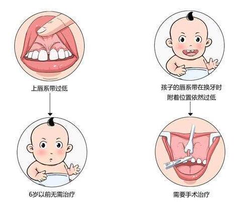 什么是唇系帶?唇系帶切除術(shù)的果如何?唇系帶切除術(shù)后如何護(hù)理?