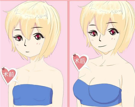 假體隆胸有什么缺點與危害