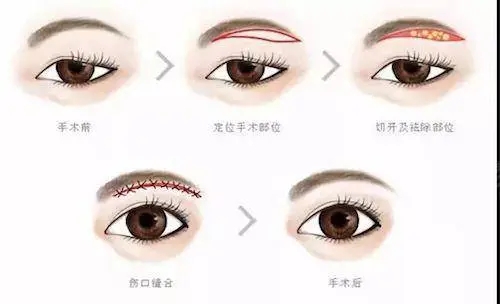 提眉5年后什么樣？提眉手術(shù)果能維持幾年？