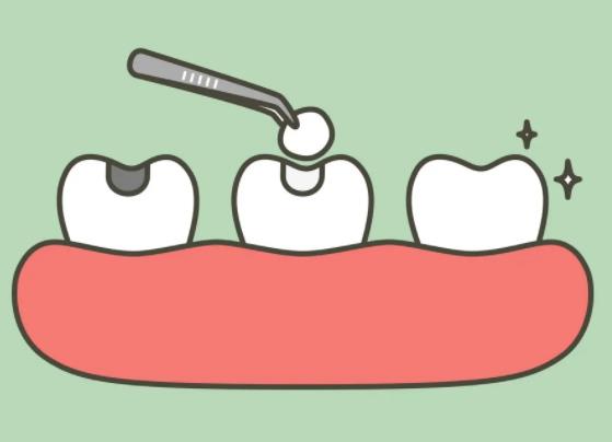 2022補(bǔ)牙多少錢一顆牙？補(bǔ)牙的方法和價(jià)位詳解！