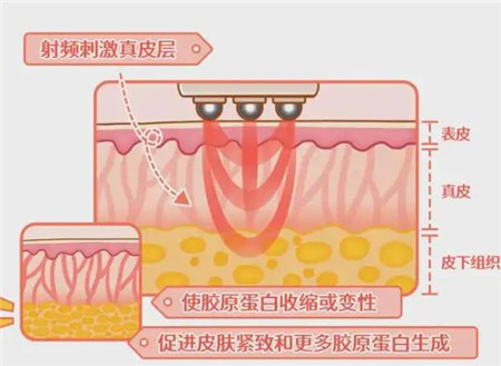 熱瑪吉的原理是什么?優(yōu)點(diǎn)有哪些?注意事項(xiàng)有哪些?