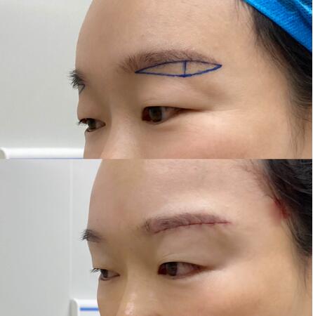 切眉術(shù)果好嗎?什么是切眉術(shù)?