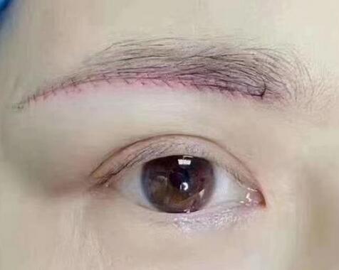 什么是切眉術(shù)?切眉術(shù)的優(yōu)勢(shì)有哪些?