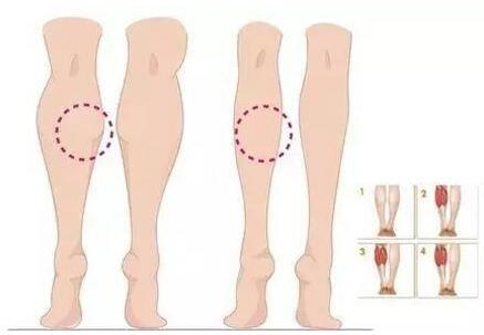 瘦腿有哪些誤區(qū)?瘦腿要注意什么?