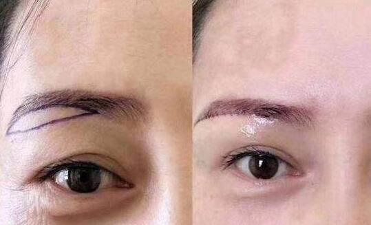 切眉術(shù)改良了哪些面部問(wèn)題?