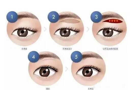 什么是懸骨切眉術(shù)?懸眉術(shù)適合誰(shuí)?