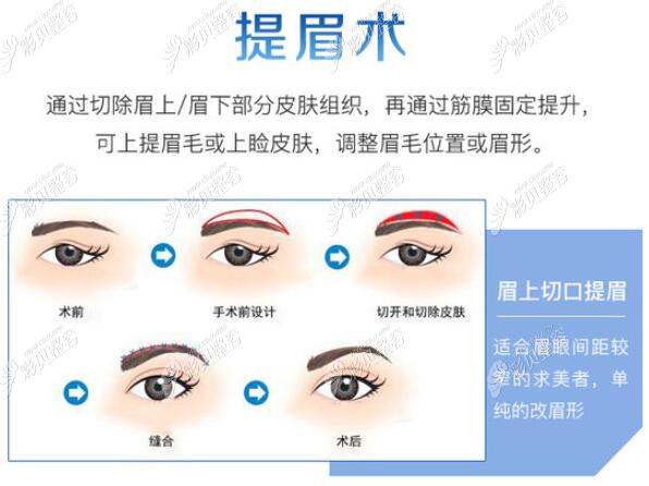 提眉術(shù)后注意事項有哪些?提眉術(shù)后多久可以恢復(fù)?