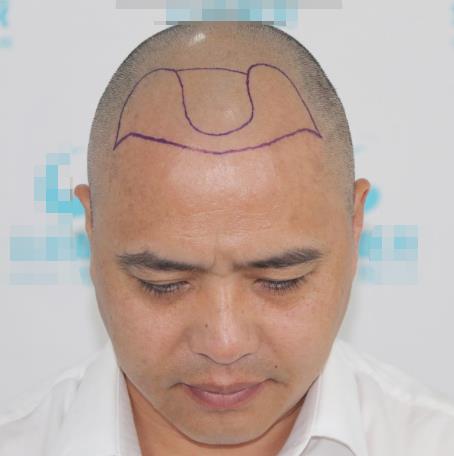 北京中日友好醫(yī)院植發(fā)多少錢?價格表+醫(yī)生案例果圖雙奉上!