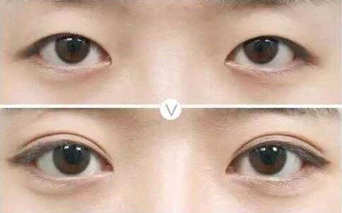 雙眼皮修復(fù)高不?什么時候修復(fù)雙眼皮比較好?