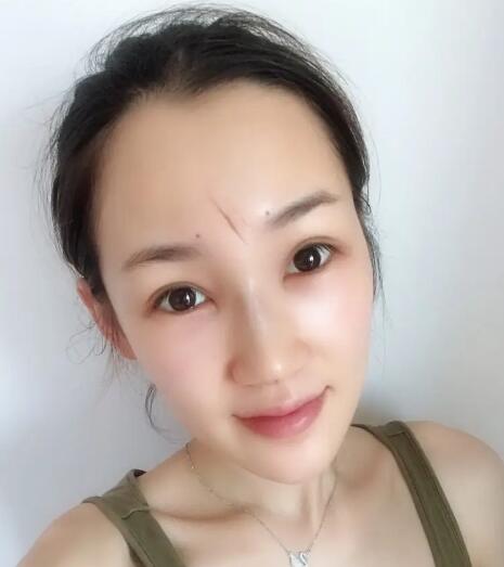 膠原蛋白隆鼻能維持多長時間