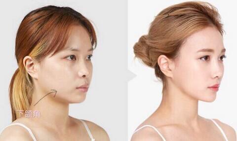 下頜角磨骨整形后臉會(huì)崩嗎? 頜角磨骨后果如何?