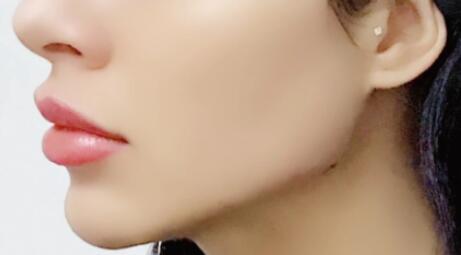 下頜角切除多少錢?術后護理有哪些要注意的?