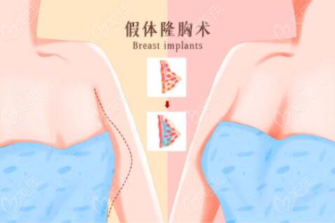 假體豐胸手術價格多少?假體豐胸手術多久恢復?