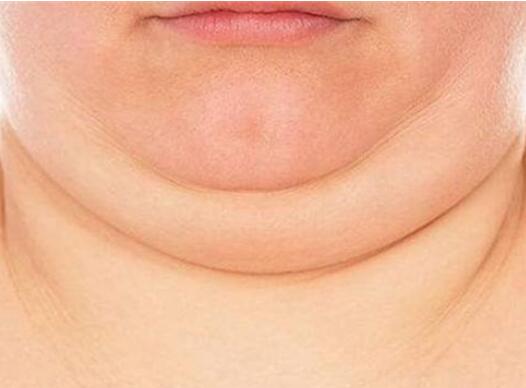 廣州下巴整形價格多少錢?整容豐下巴的價格影響因素有哪些?