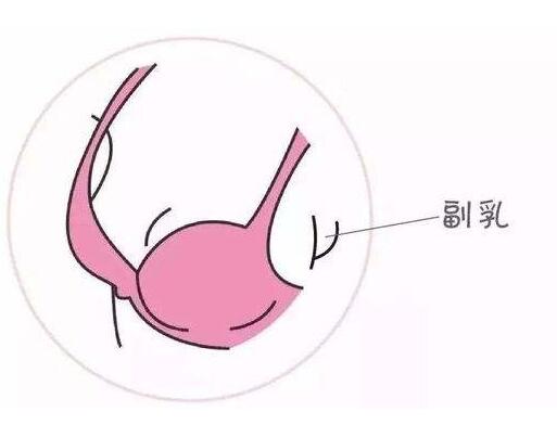 副乳切除術(shù)痛不痛？術(shù)前的注意事項？