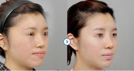 【科普】頜面外科整形包括哪些手術?