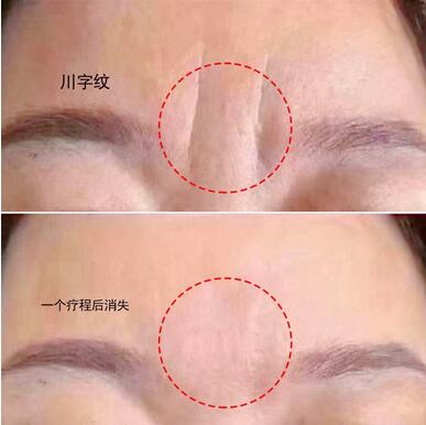 眉間紋打了玻尿酸多久才能恢復(fù)?