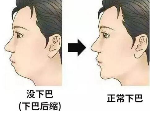 怎樣快速讓下巴變尖變長呢?好方法在這里