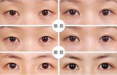 三點(diǎn)定位雙眼皮多少錢_價(jià)格介紹