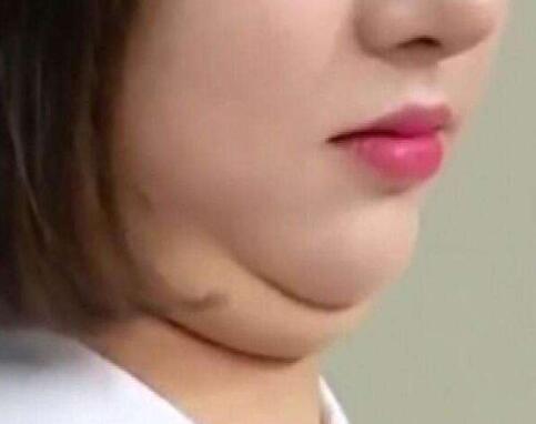 去掉厚重的雙下巴，可不止一種方法!