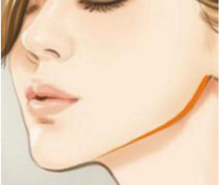 下頜角整形有幾種手術(shù)方式?術(shù)后護(hù)理過程需要注意什么?