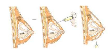注射隆胸手術(shù)價(jià)格_多少錢(qián)?