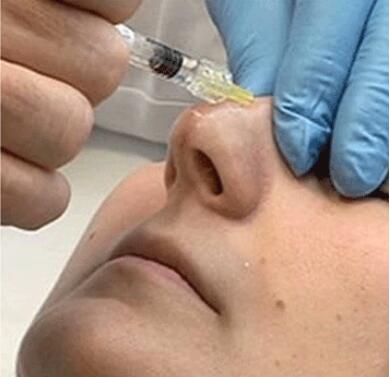 注射隆鼻手術(shù)價(jià)格