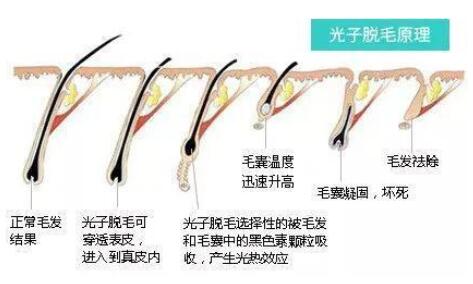 做好以下光子脫毛術(shù)前準(zhǔn)備不會疼