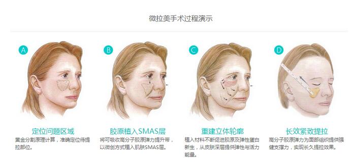 提升面部之后臉變大了怎么辦?