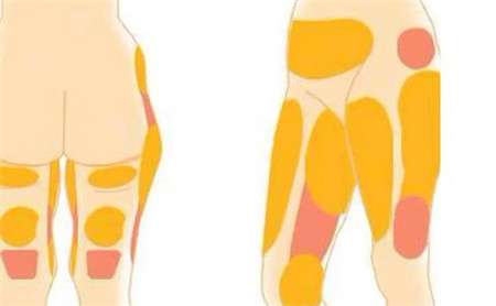 超聲波溶脂減肥有哪些優(yōu)勢(shì)