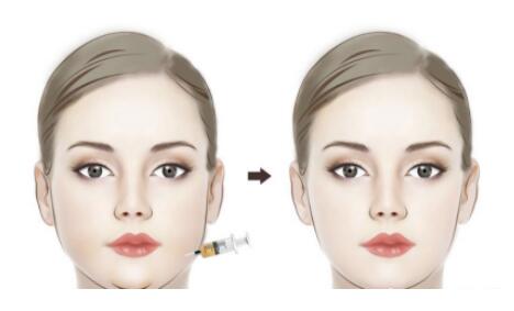 面部吸脂的價格是多少?果怎么樣?