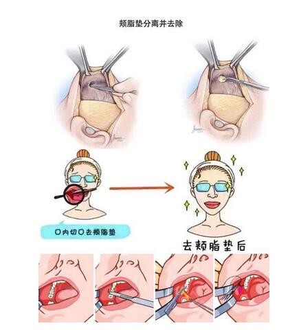 去頰脂墊恢復(fù)期是多久?過程需要注意哪些?