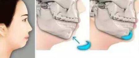 膨體隆下巴多久會(huì)變軟?容易取出來(lái)嗎?