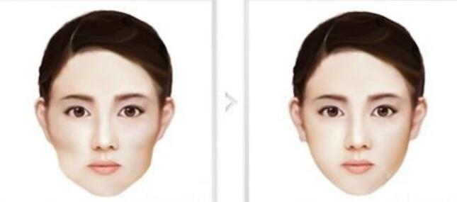 顴骨整形后應(yīng)該如何護(hù)理?感染了怎么辦?