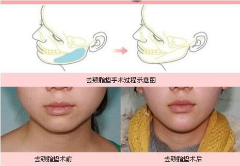去頰脂墊果嗎?會(huì)不會(huì)反彈?