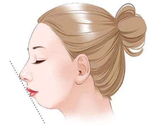 后縮下顎角怎么整形?