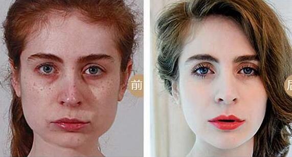 做冷凍法去黃褐斑調節(jié)果怎么樣?果保持時間多久?