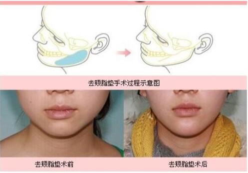 去頰脂墊有副作用嗎?術(shù)后怎么護(hù)理?