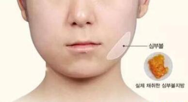 去頰脂墊價(jià)格貴不貴?收費(fèi)情況說明