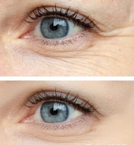 去除魚尾紋的方法有哪些?哪種方法比較好?