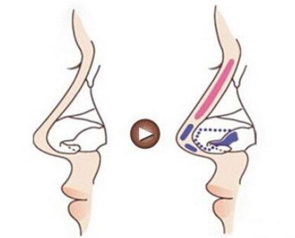 取出隆鼻假體嗎?需要多少錢?