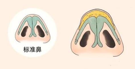 什么方法可以讓鼻頭變尖?