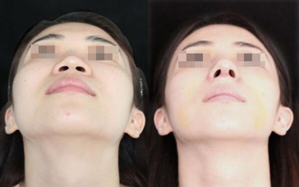 做鼻小柱延長調節(jié)果怎么樣?果保持時間多久?