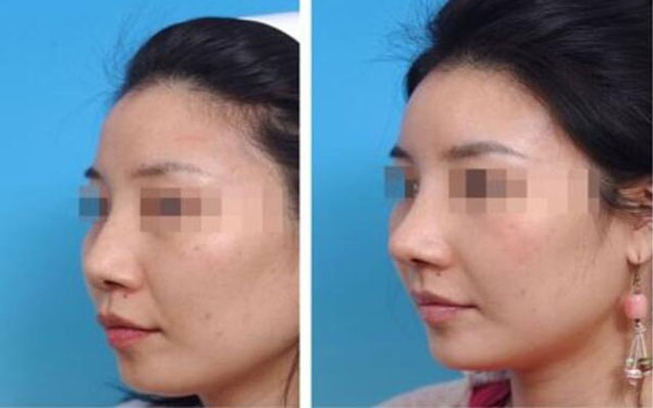 做鼻尖缺損修復(fù)調(diào)節(jié)果怎么樣?果保持時間多久?