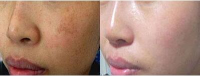 做電離子調(diào)節(jié)去雀斑調(diào)節(jié)果怎么樣?果保持時間多久?